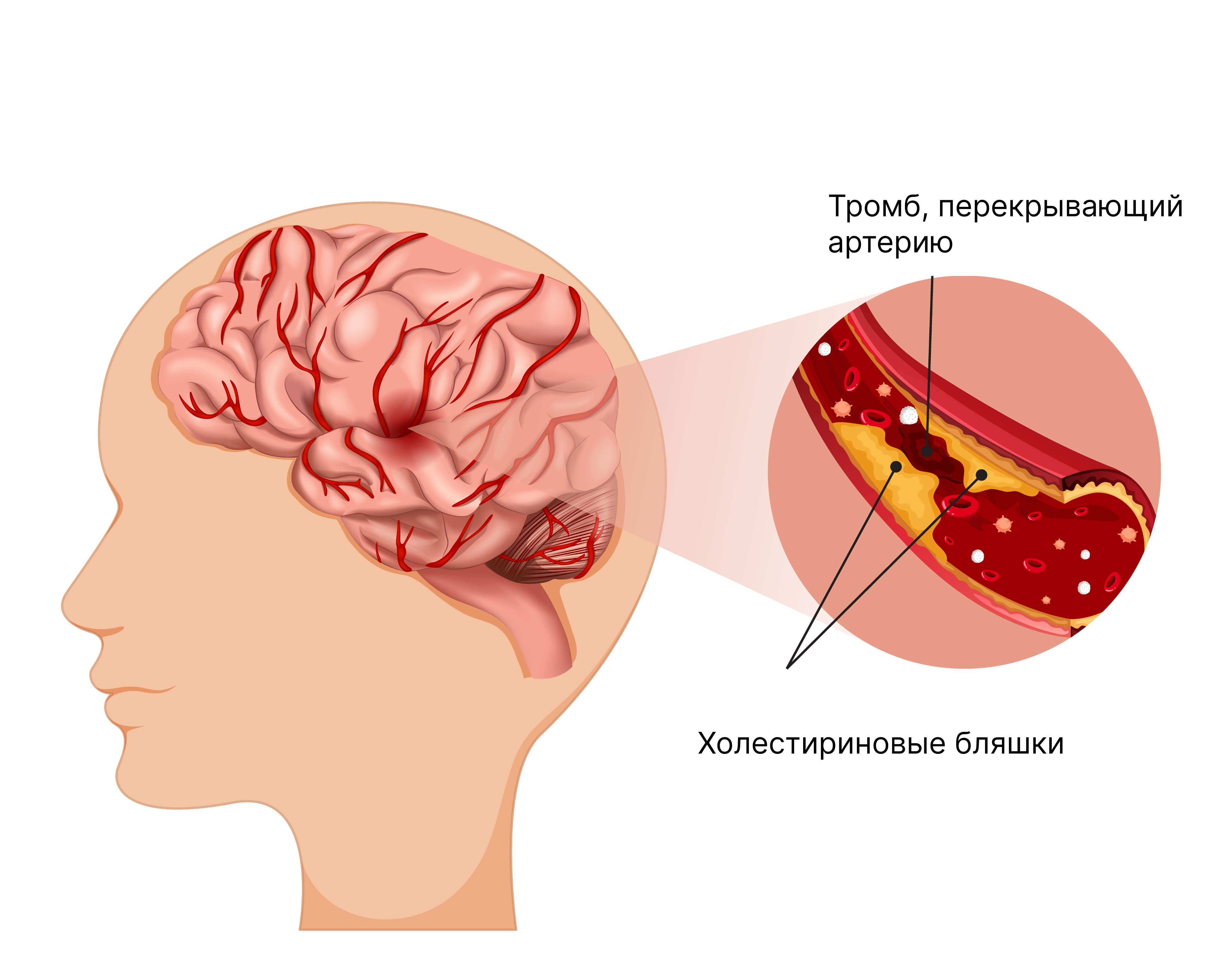 образование тромба в артерии перед инсультом